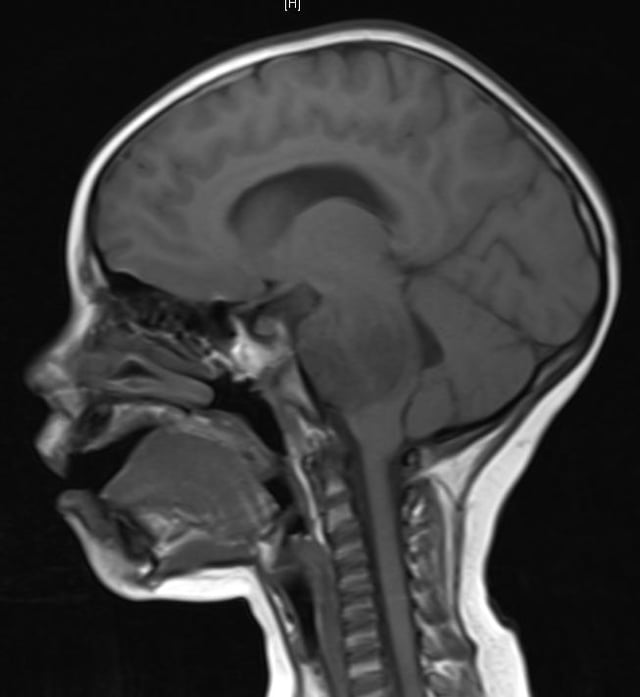 A brainstem glioma in four-year-old. MRI, sagittal, without contrast