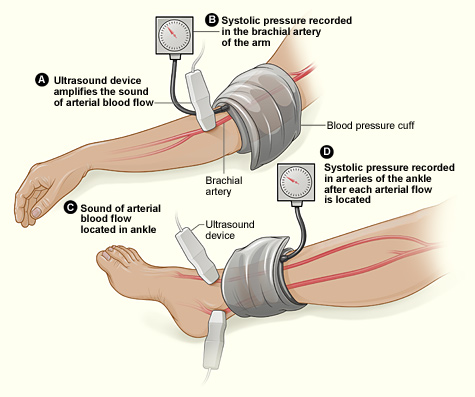 The Ankle-Brachial Index is depicted here. Note: ultrasound enhancement of pulses is not required but may be helpful.