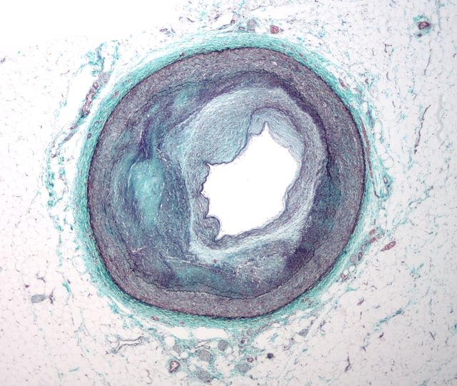 Micrograph of an artery that supplies the heart showing significant atherosclerosis and marked luminal narrowing. Tissue has been stained using Masson's trichrome.