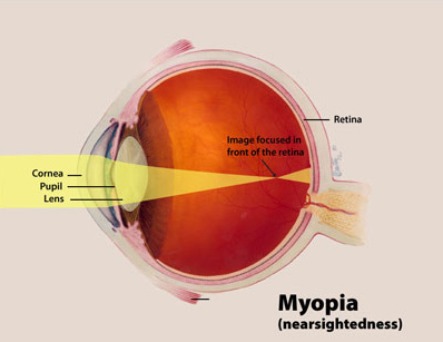 Anatomical diagram of myopia or nearsightedness.