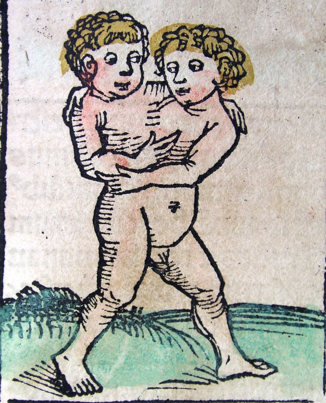 Conjoined brothers from Nuremberg Chronicle (1493)