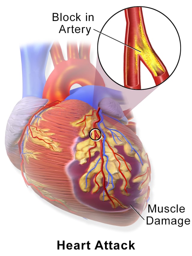 A myocardial infarction occurs when an atherosclerotic plaque slowly builds up in the inner lining of a coronary artery and then suddenly ruptures, causing catastrophic thrombus formation, totally occluding the artery and preventing blood flow downstream.