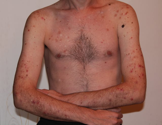 Skin-picking disorder