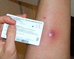 Although usually carried without symptoms, MRSA often presents as small red pustular skin infections