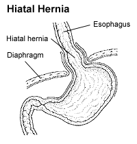 Diagram of a hiatus hernia (coronal section, viewed from the front).