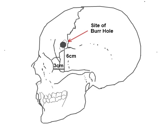 Site of borehole for the standard pre-frontal lobotomy/leucotomy operation as developed by Freeman and Watts