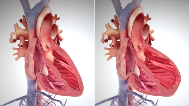 Model of a normal heart, with contracted muscle (left); and a weakened heart, with over-stretched muscle (right).