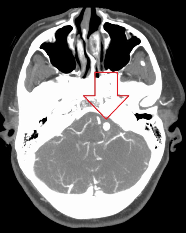 Ruptured 7mm left vertebral artery aneurysm resulting in a subarachnoid hemorrhage as seen on a CT scan with contrast