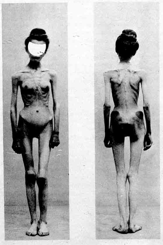 Two images of an anorexic woman published in 1900 in "Nouvelle Iconographie de la Salpêtrière". The case was entitled "Un cas d'anorexie hysterique" (A case of hysteric anorexia).