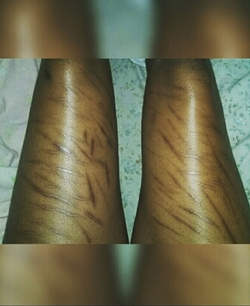 Scar that Kenidra R. Woods received on her legs.