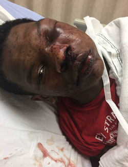 Photo of Ulysses Wilkerson from the beating that he received.