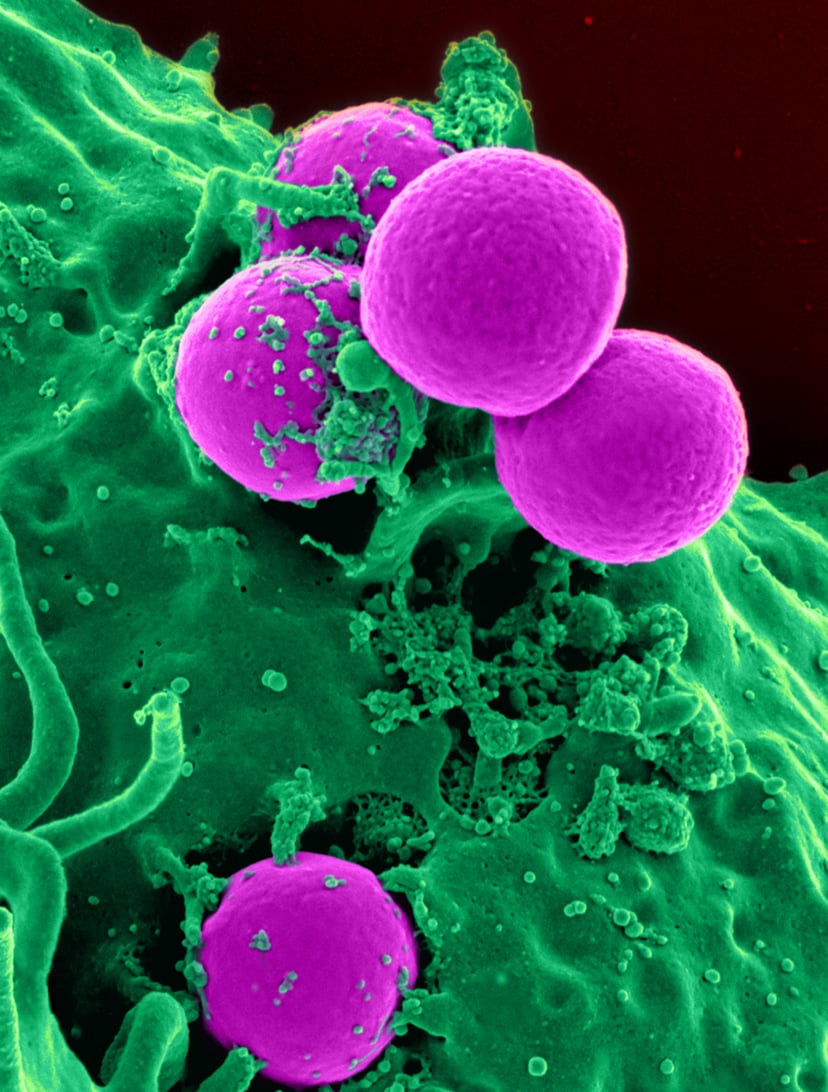 Methicillin-resistant Staphylococcus aureus