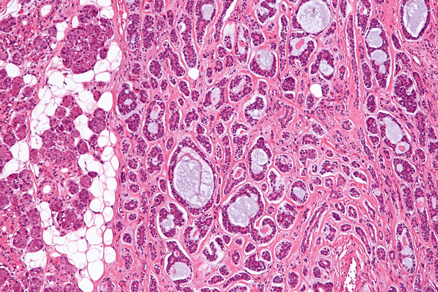 Adenoid cystic carcinoma