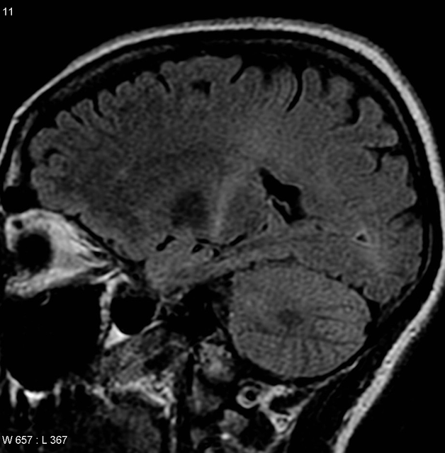 Amyotrophic lateral sclerosis