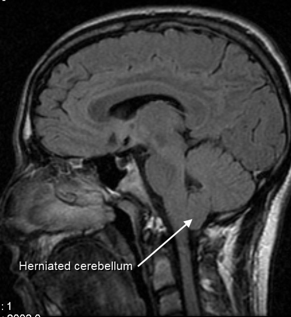 Arnold–Chiari malformation