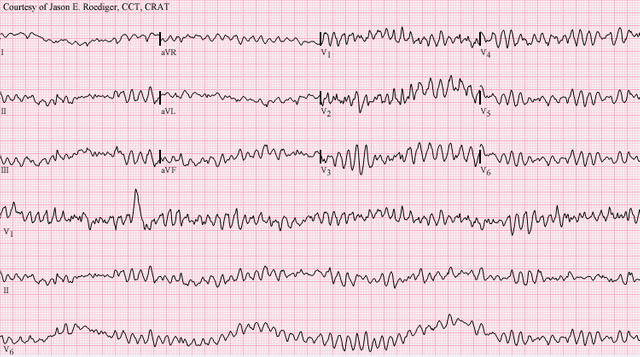 Cardiac arrhythmia