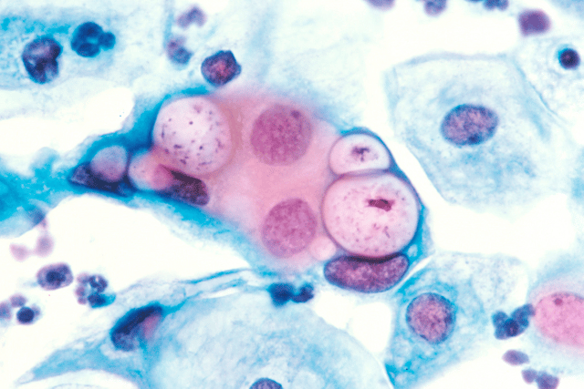 Chlamydia infection