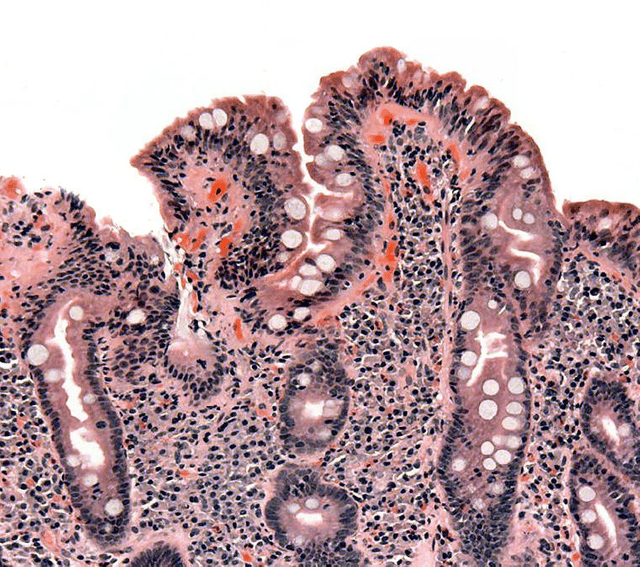 Coeliac disease