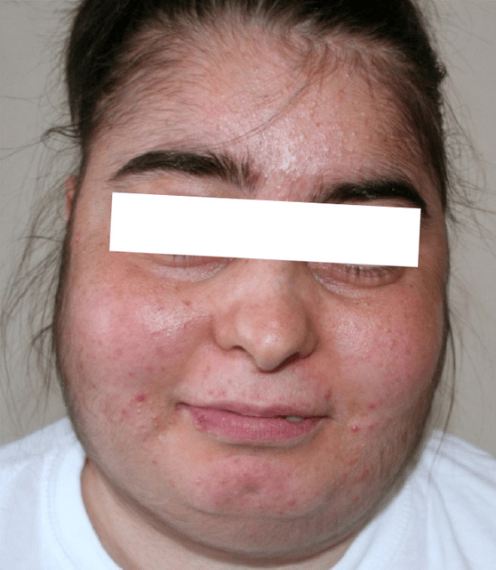 Cushing's syndrome