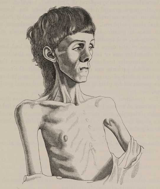 Eating disorder