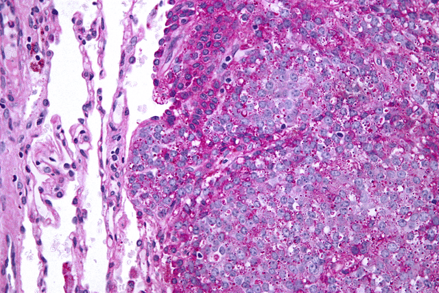 Ewing's sarcoma