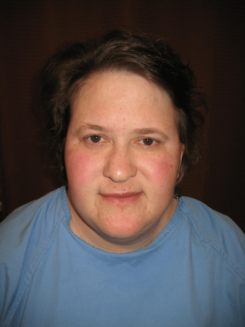 Langer–Giedion syndrome