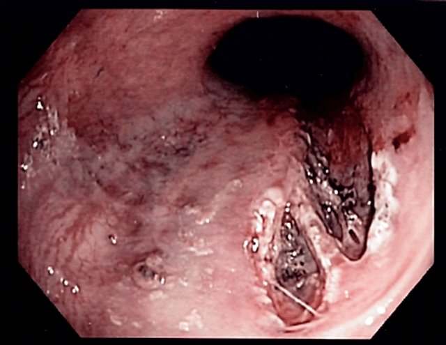 Mallory–Weiss syndrome