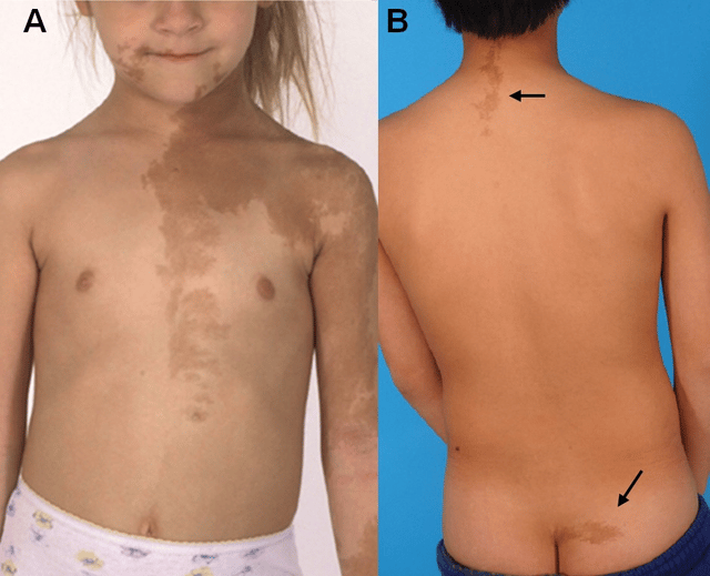 McCune–Albright syndrome