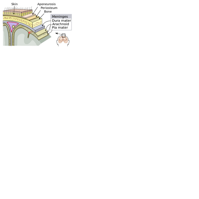Meningitis
