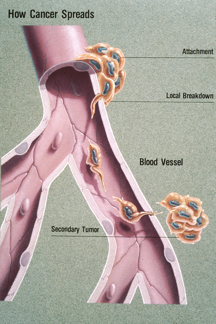 Metastasis