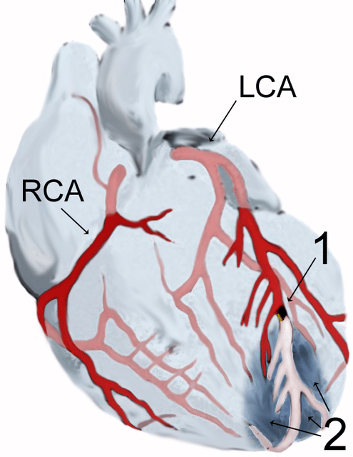 Myocardial infarction