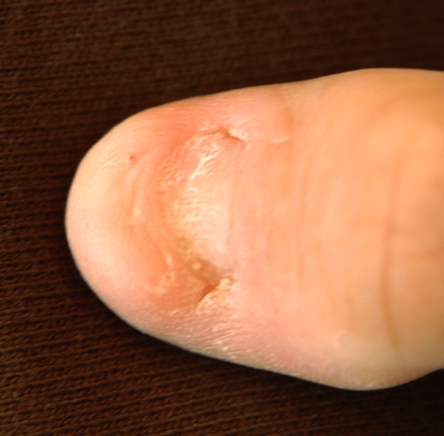Nail–patella syndrome