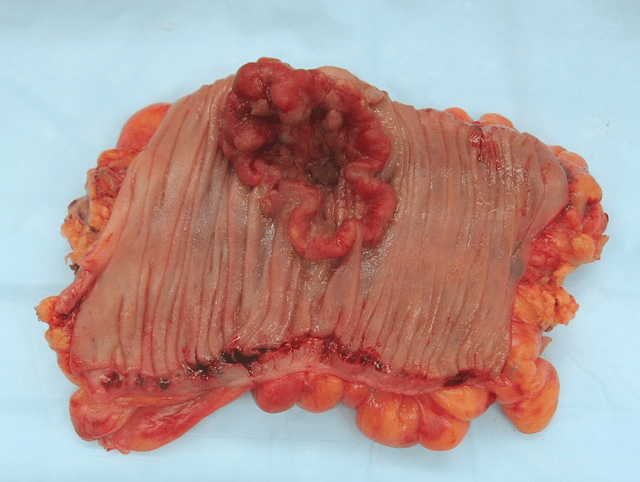 Neoplasm