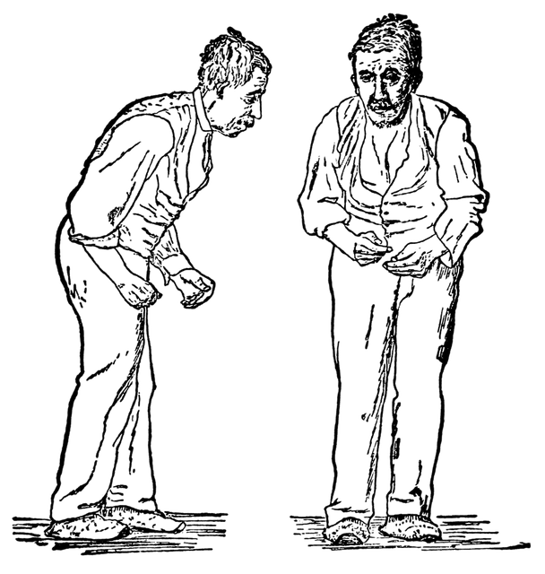 Parkinson's disease