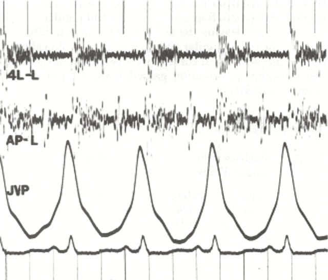 Phonocardiogram