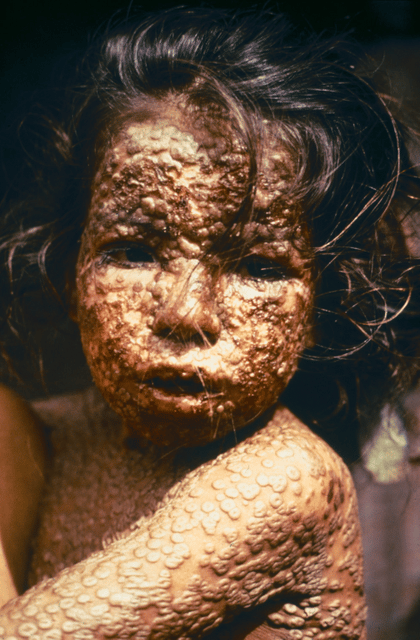 Smallpox