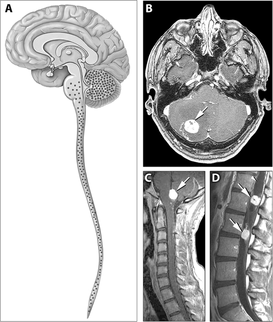Von Hippel–Lindau disease