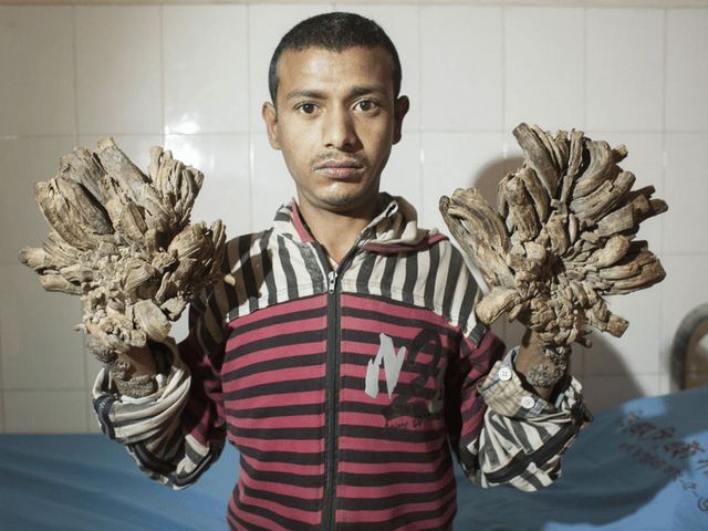 Abul Bajandar (Tree Man)