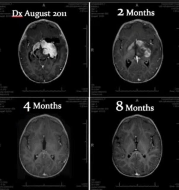Studies on Cannabinoids in Cancer