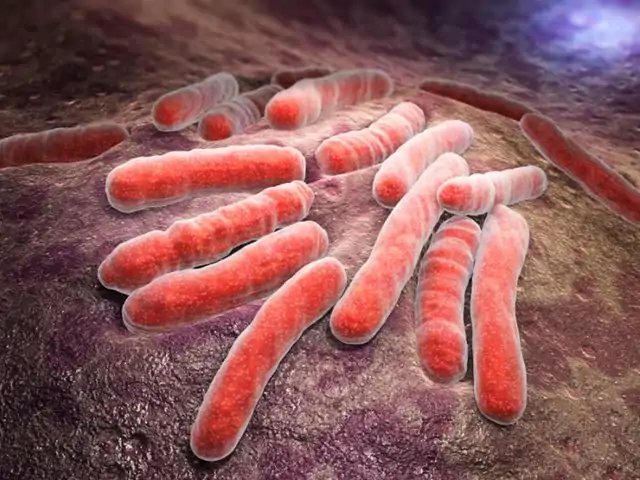 ICD-10: Tuberculosis (A15-A19)