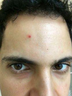 Mahbod Moghadam's zit (July 2016)