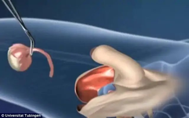 Sex Reassignment Surgery (male-to-female)