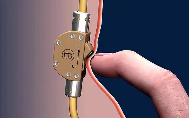 Sperm switch (bimek slv)